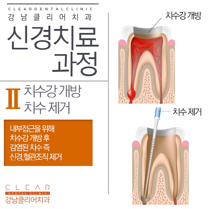 치아 신경치료 과정 순서 통증 등 신경치료의 모든것 관련 이미지 5