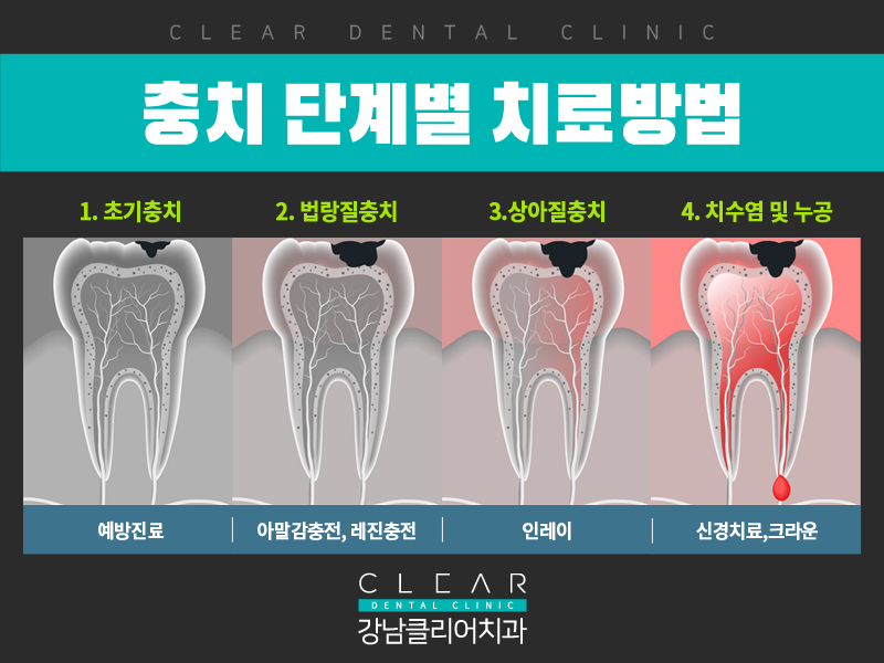 강남충치치료 레진,인레이 단계별 치료방법 관련 이미지 3