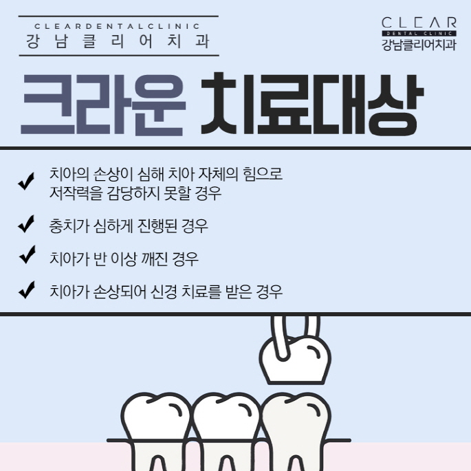 강남 치아 크라운 치료 가격 종류 등 모든것 관련 이미지 3