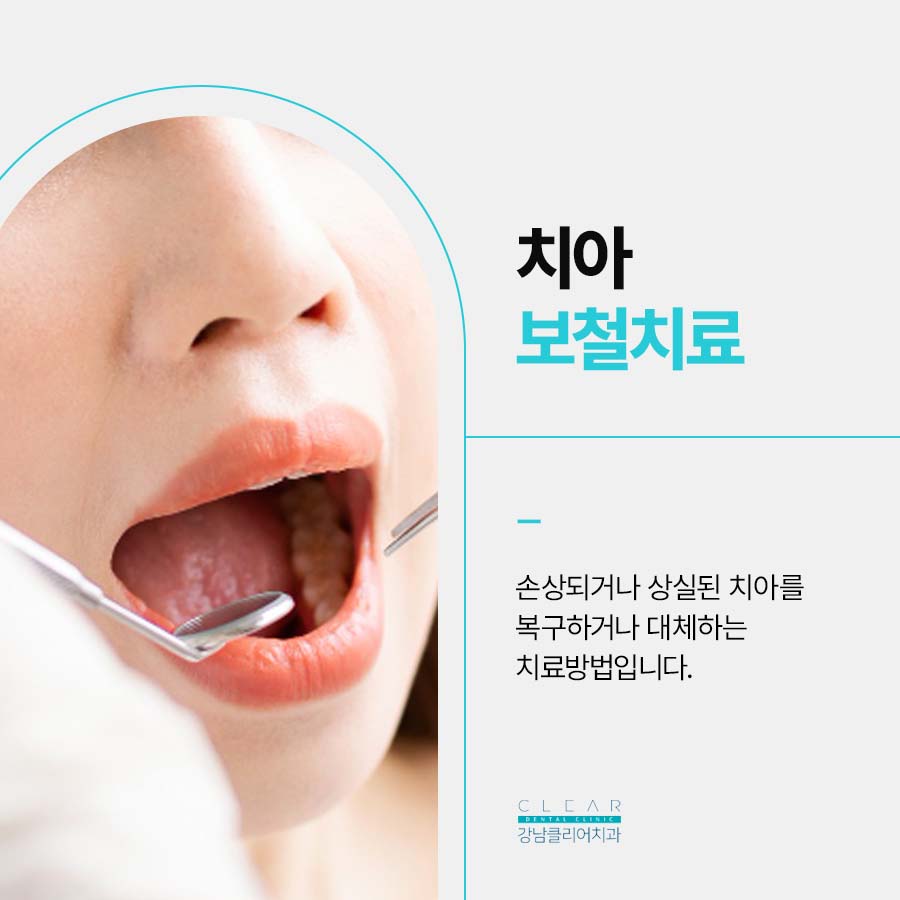 치아보철치료 종류 단계에 따라 관련 이미지 2
