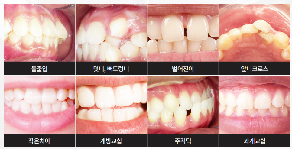 도곡동교정치과 반듯한 치아를 갖기 위한 준비 관련 이미지 7