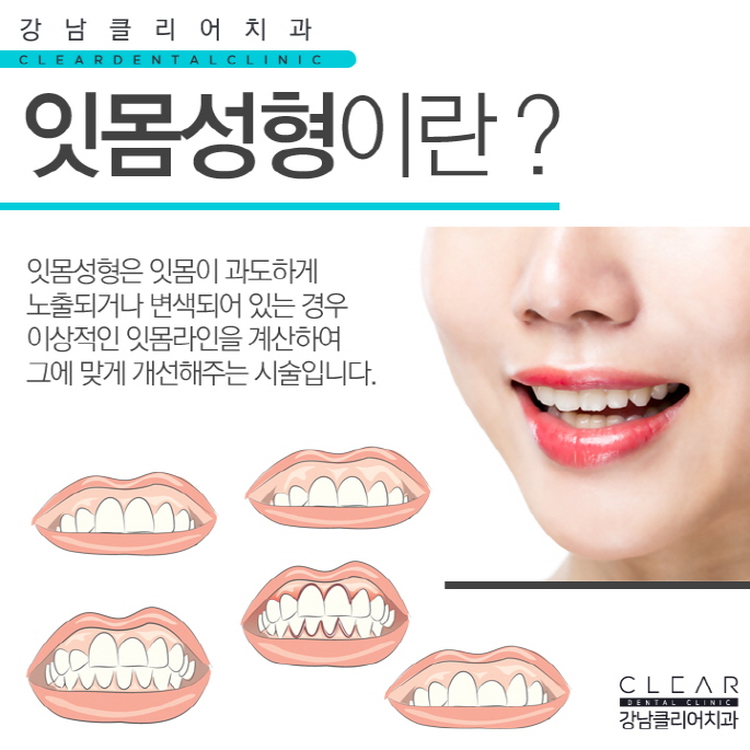 연예인잇몸성형, 잇몸성형 자신감 있는 미소 되찾기 관련 이미지 2
