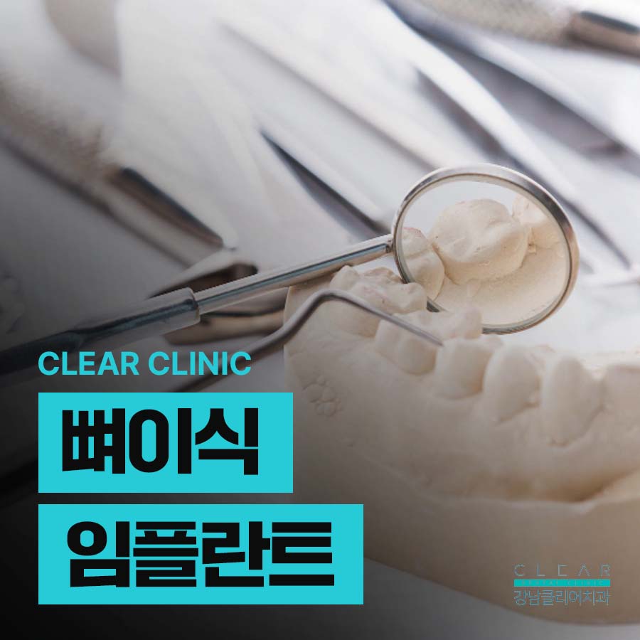 치과 뼈이식 임플란트 기간 과정 주의사항은? 관련 이미지 1