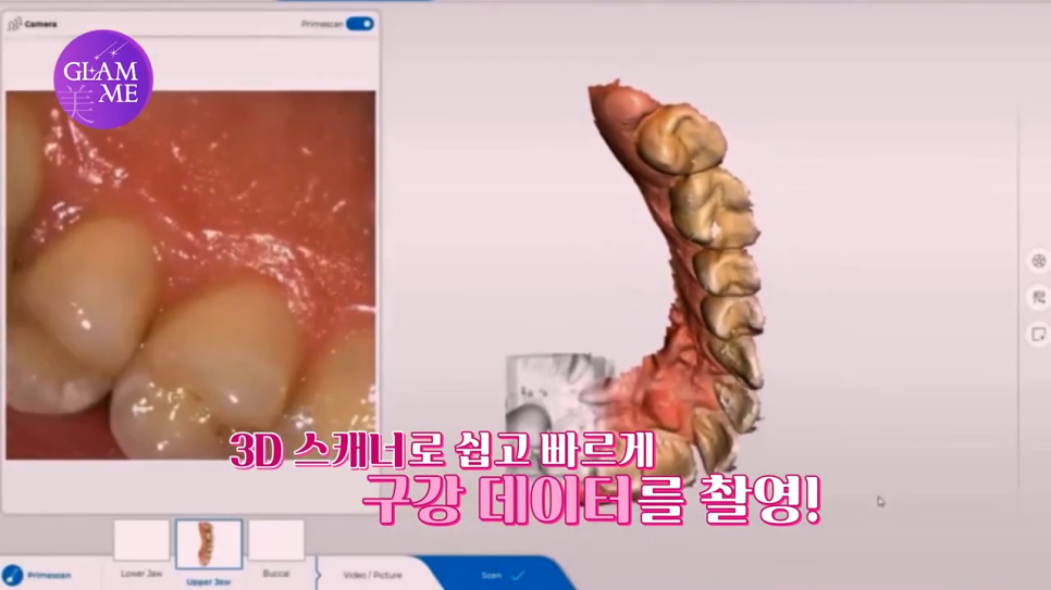강남역임플란트치과 자연치에 가깝게 관련 이미지 10