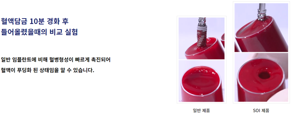 오스템 소이임플란트 합리적 선택해야 할 땐 관련 이미지 7