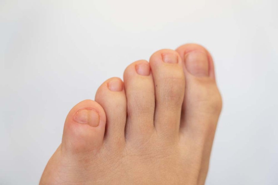 엄지발가락 통증 통풍 초기증상 요산 정상수치는? 관련 이미지 2