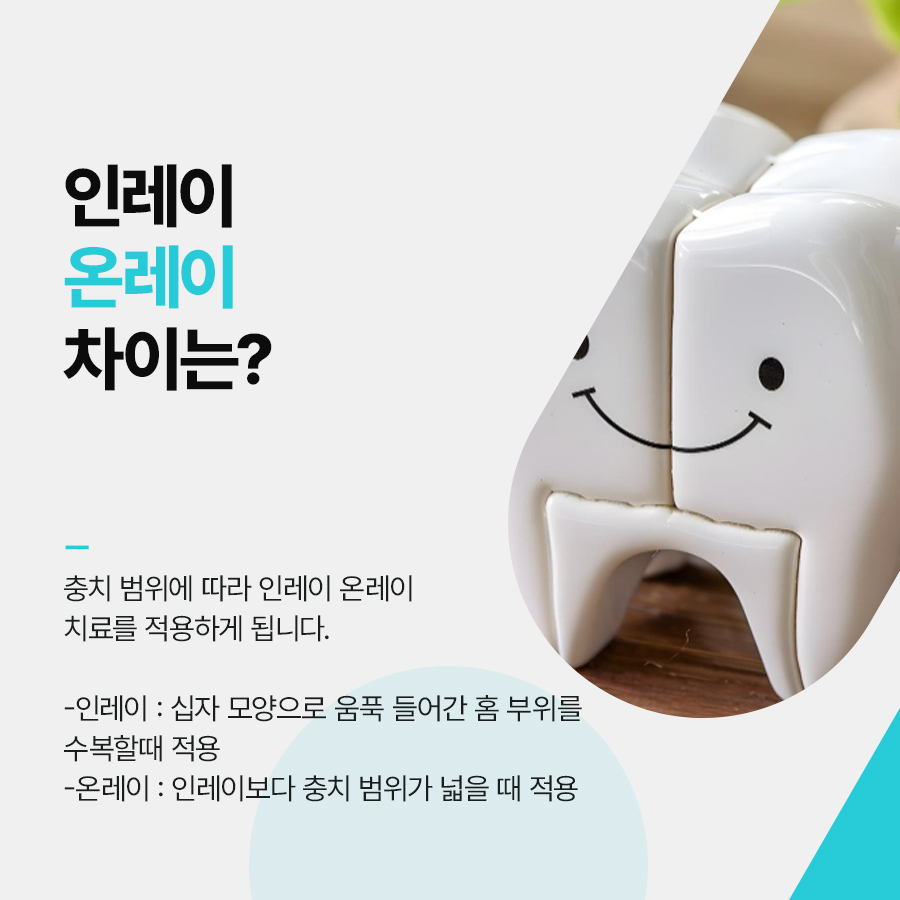 인레이 온레이 치료 다른점은 무엇일까 관련 이미지 2