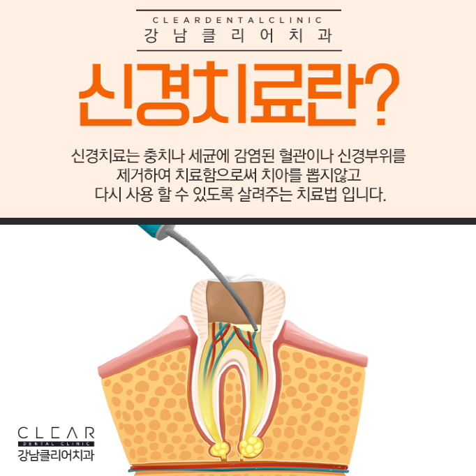 치과신경치료, 신경치료 후 크라운 꼭 해야하는걸까? 관련 이미지 3
