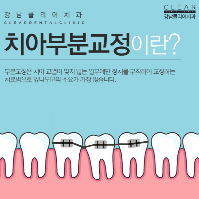 강남역치아교정치과 나에게 맞는 장치 선택이 중요 관련 이미지 6
