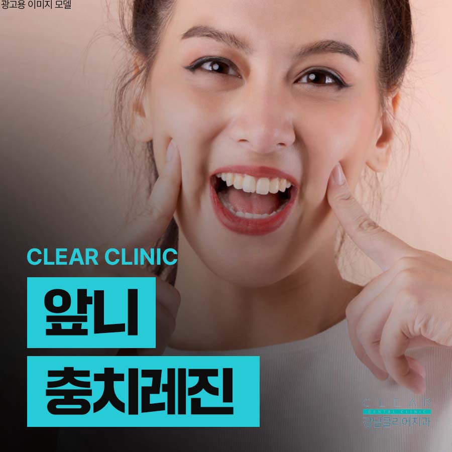 앞니 충치 레진 치료 자연스러워야 하니까 관련 이미지 1