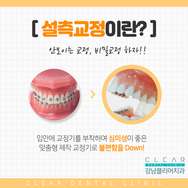 강남역 안보이는 시크릿교정 설측교정! 관련 이미지 2