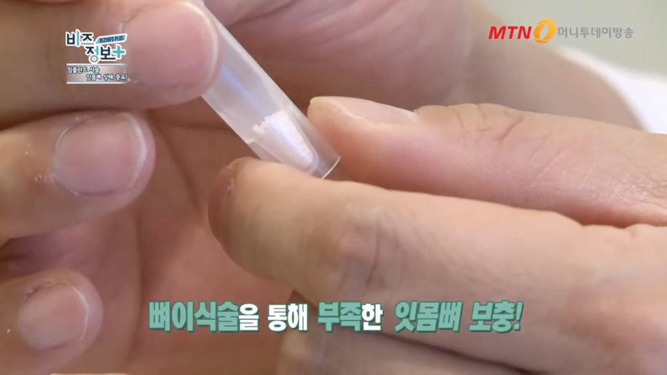 강남역임플란트치과 뼈이식 방법으로 보다 탄탄하게 관련 이미지 6