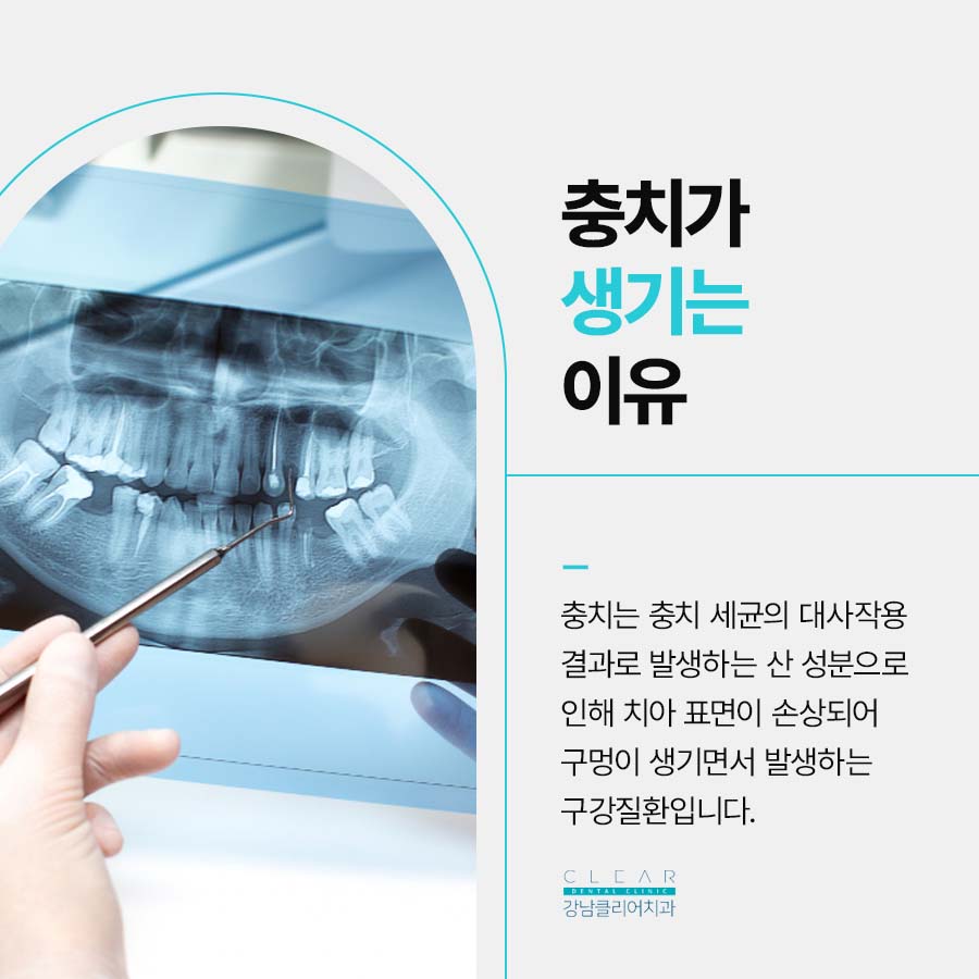 클리어치과 충치치료 어금니 레진이 가능한 경우 관련 이미지 2