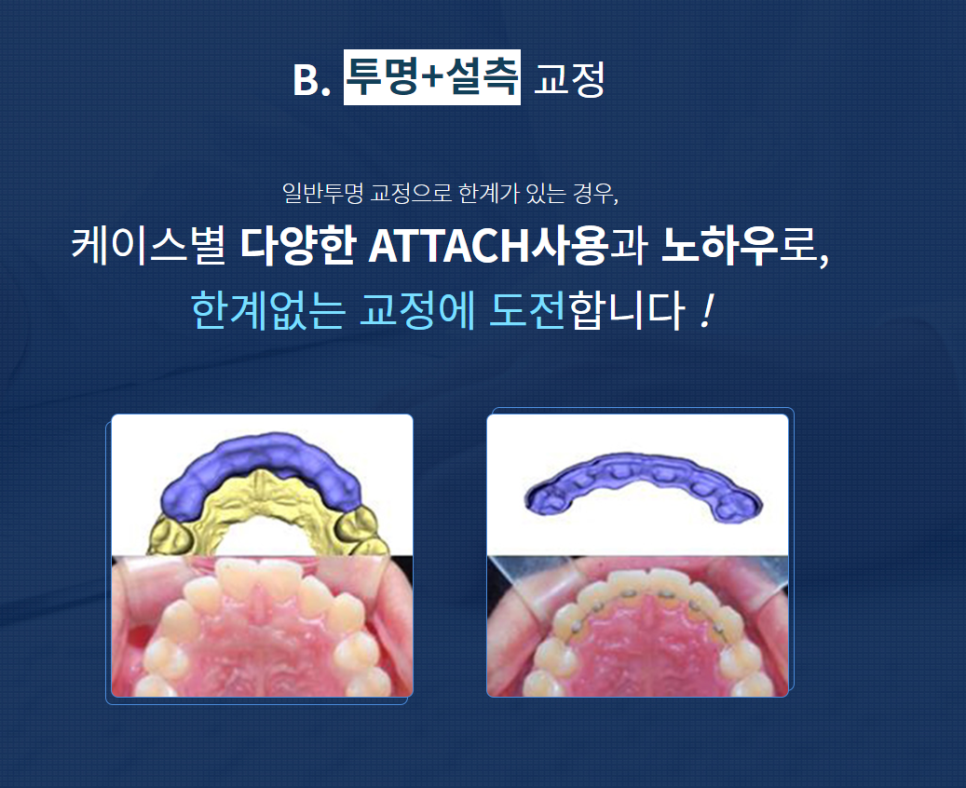 강남역 교정치과 치열을 예쁘고 고르게! 관련 이미지 4