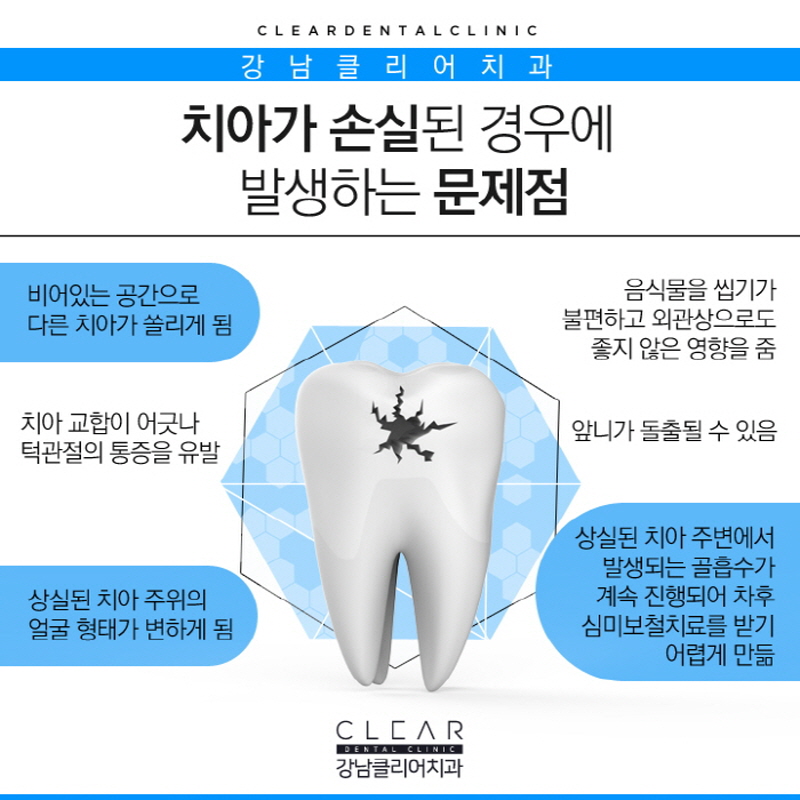강남역보철치료 내가 가지고 있는 자연치아를 보호하기 관련 이미지 3