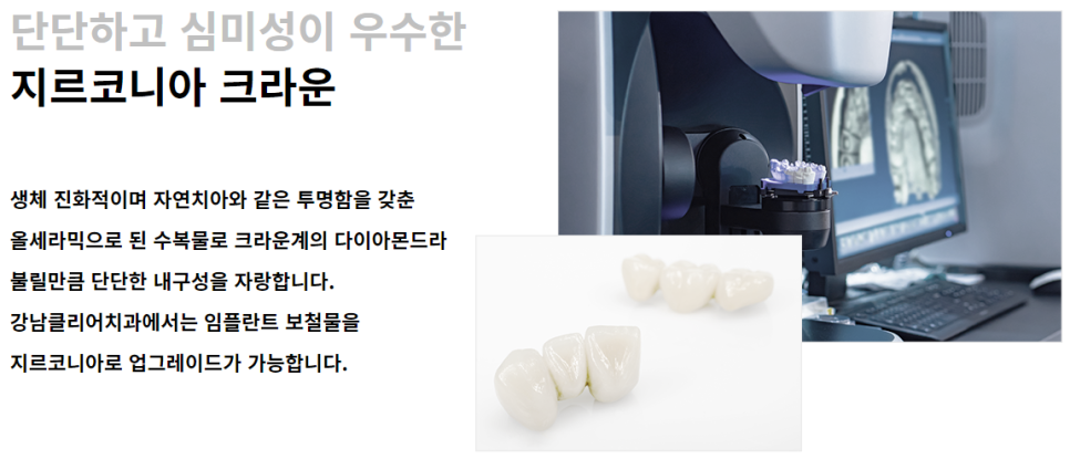 강남임플란트비용 가격 합리적으로! 관련 이미지 4