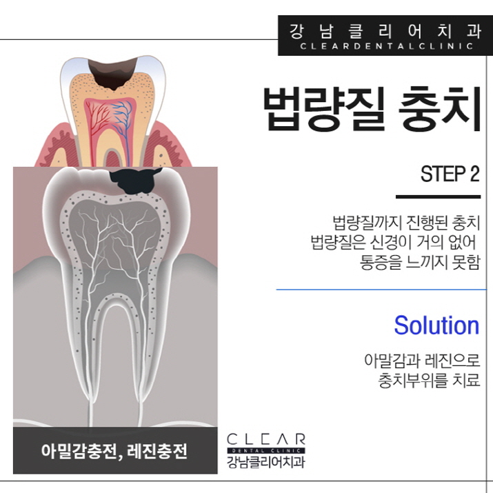 충치치료방법 단계별 필요한 보철치료까지 관련 이미지 4