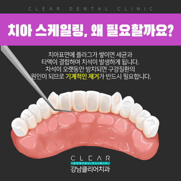 치아 스케일링 ,치석관리, 의료보험 혜택 관련 이미지 1