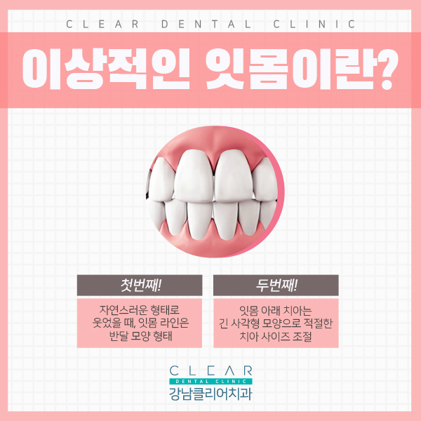 자신감 있는 스마일라인 잇몸성형 관련 이미지 3