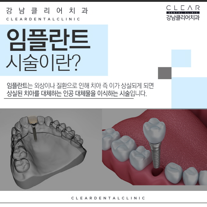 강남역임플란트치과 선택의 기준 관련 이미지 2