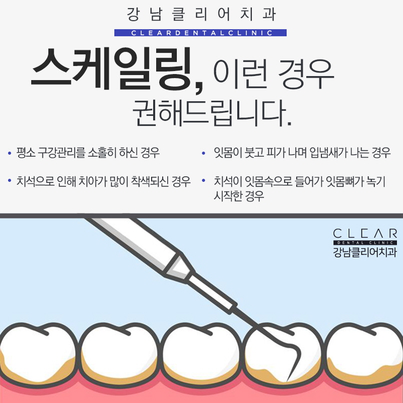 구강관리의 시작 치아스케일링 보험적용까지 관련 이미지 3