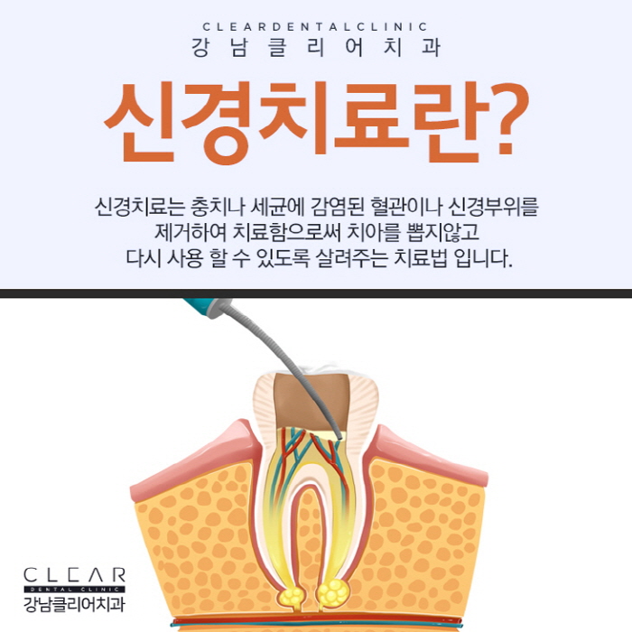치아 신경치료 가볍고 쉽게 생각해선 안된다 관련 이미지 2
