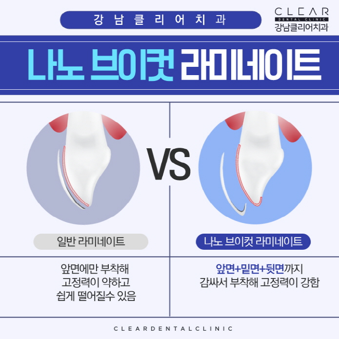 강남역라미네이트 완벽맞춤 나노브이컷 라미네이트 관련 이미지 8