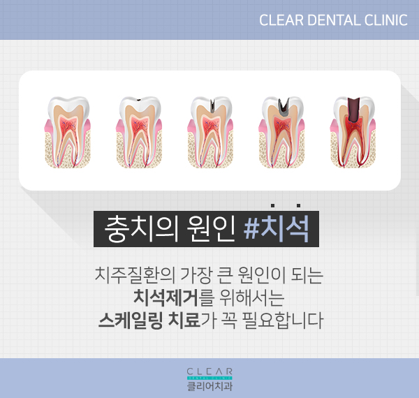 자연치아를 소중히 하기 위한, 스케일링 관련 이미지 4