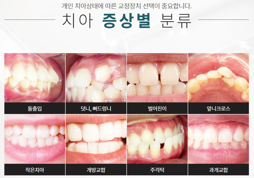 서초동치아교정치과 치열을 보기 좋게 관련 이미지 2