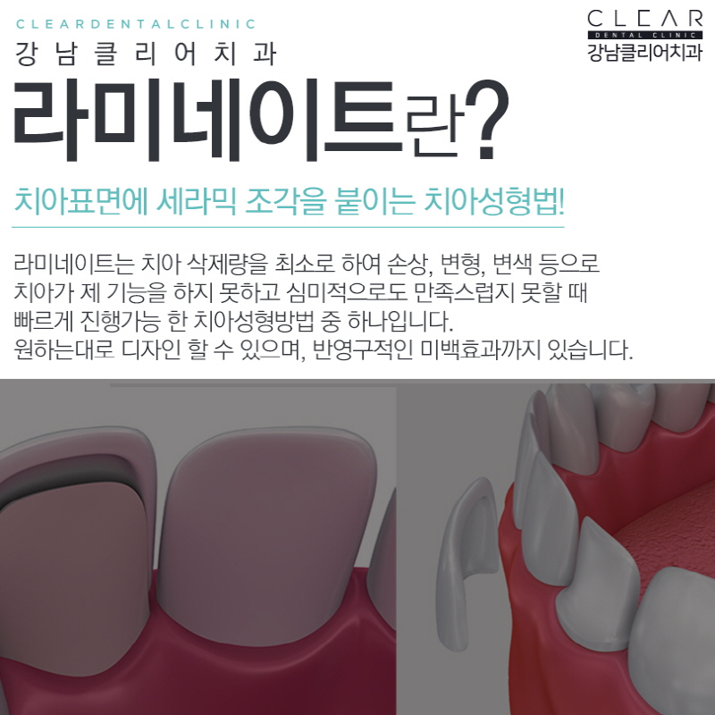강남역라미네이트 간단히 결정말고 비교하고 따져보세요 관련 이미지 2