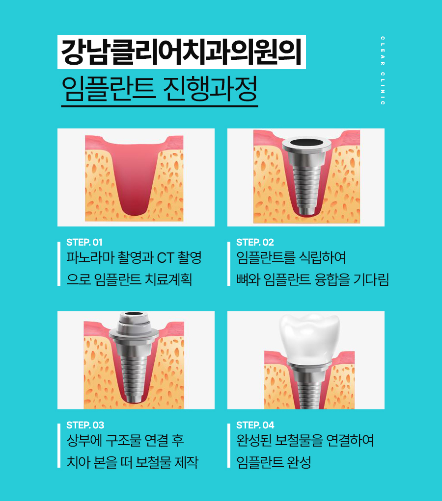 클리어치과 오스템임플란트 정품을 사용하니까 관련 이미지 5