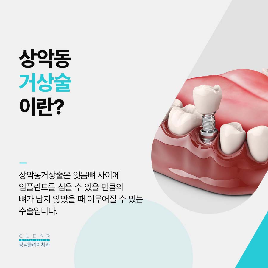 클리어치과 상악동거상술이 필요한 경우 관련 이미지 2
