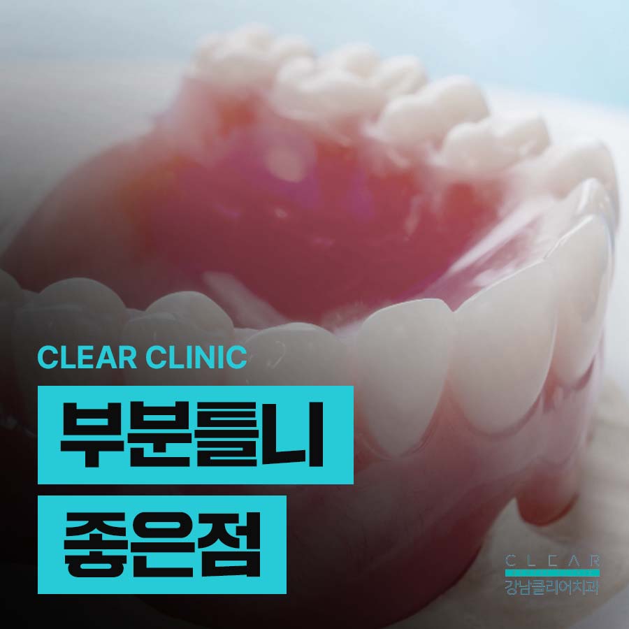 부분틀니 좋은점 및 제작시 주의할점 관련 이미지 1