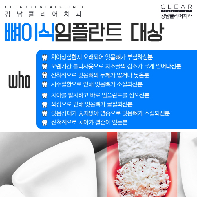 뼈이식임플란트 무엇이며 뼈이식은 왜 중요할까? 관련 이미지 5