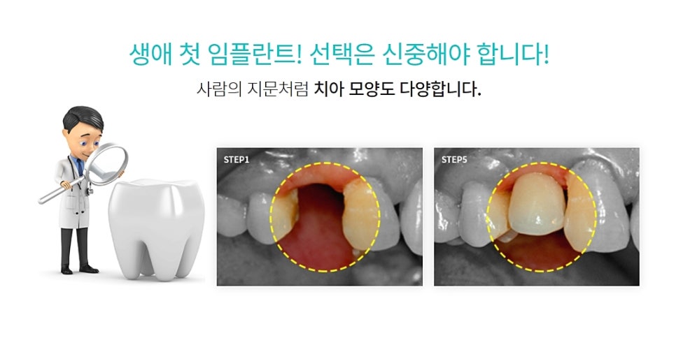 클리어치과 임플란트 이젠 고민 그만하고 관련 이미지 8