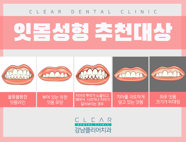 자신감 있는 스마일라인 잇몸성형 관련 이미지 4