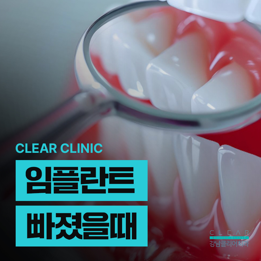 임플란트 빠졌을때 빠지는 이유 대처법 알려드려요 관련 이미지 1