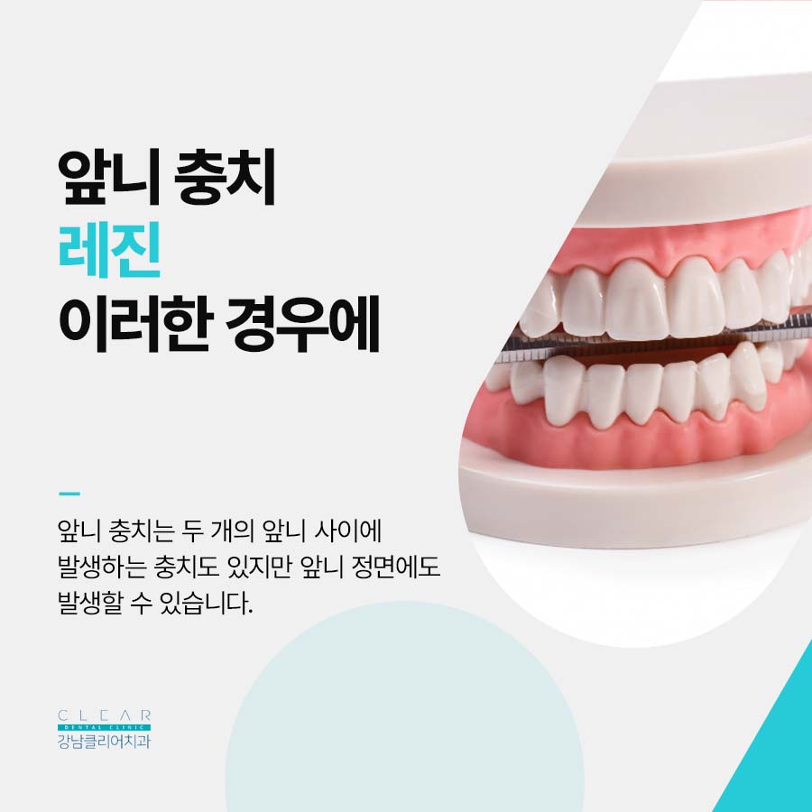 앞니 충치 레진 치료 자연스러워야 하니까 관련 이미지 2