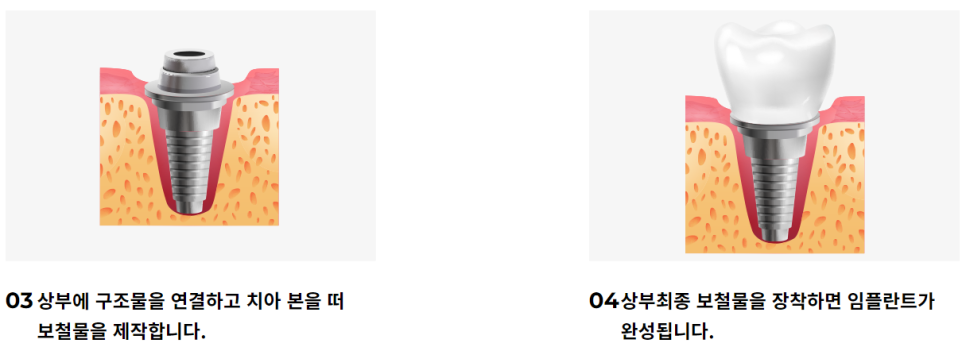 강남 논현동 임플란트잘하는곳 체계적인 맞춤 치료를 관련 이미지 7