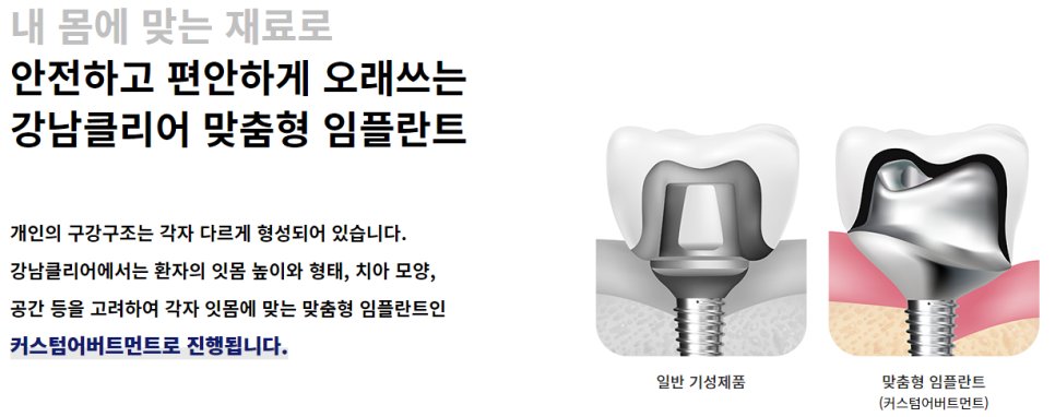 65세이상임플란트 맞춤형으로 빈틈없이 관련 이미지 2