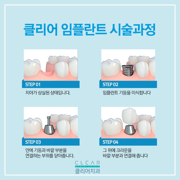 내 생에 첫 임플란트 관련 이미지 4