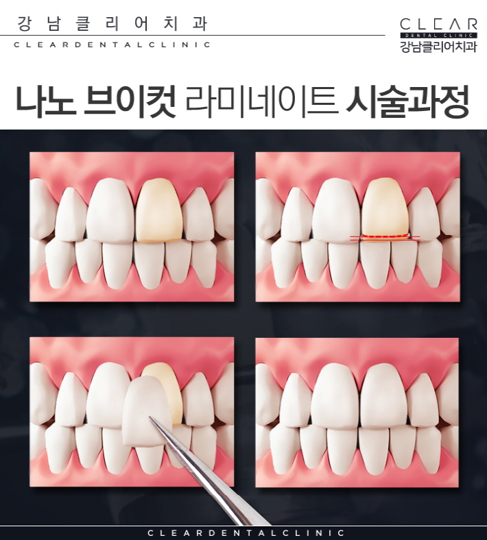 강남역라미네이트 잘하는곳 맞춤 제작 나노V컷 라미네이트 관련 이미지 7
