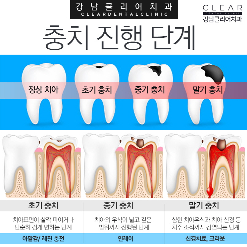 강남역충치치료 걱정보단 빠른 치료가 중요 관련 이미지 3
