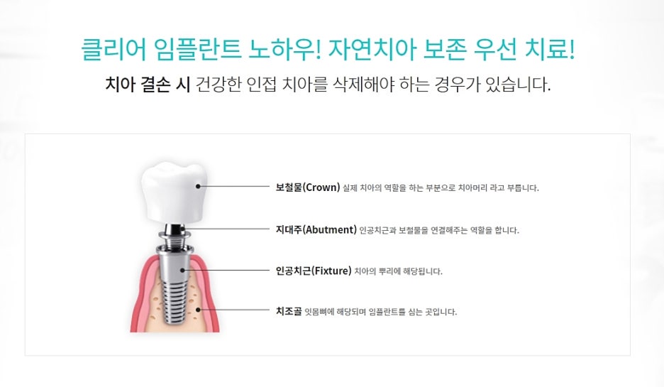 강남 임플란트치과 파악에 신경써야 관련 이미지 3