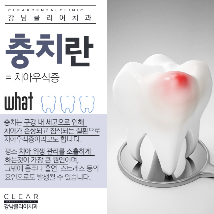 강남역충치치료 단계별 달리지는 치료방법 관련 이미지 2