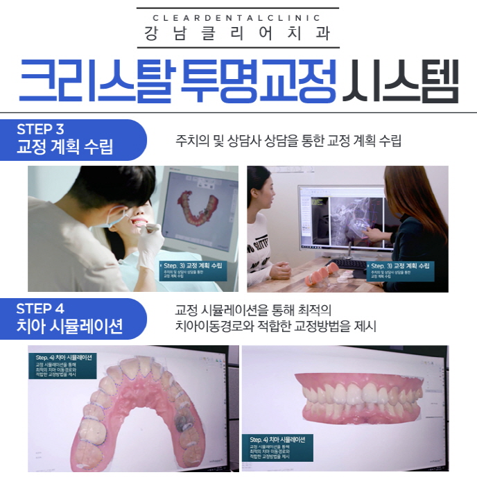 강남투명교정 치과 기존 투명교정 문제점 보완 관련 이미지 6