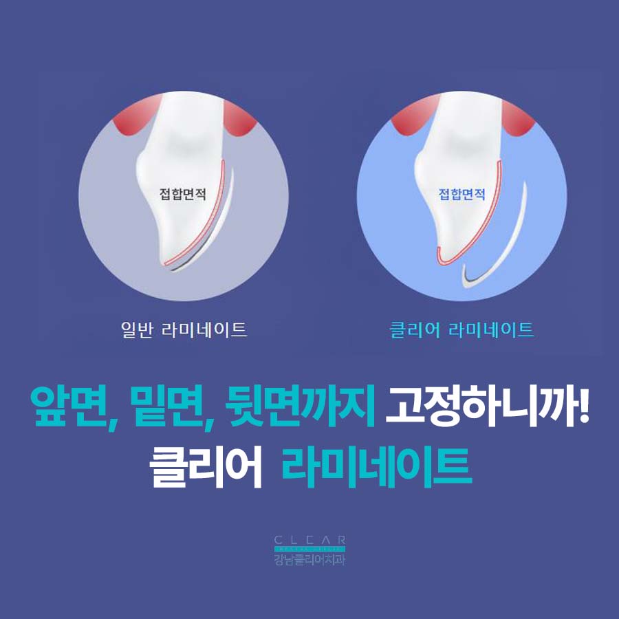 강남클리어치과 라미네이트 적절한 치아삭제가 관건 관련 이미지 4