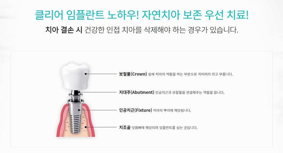 강남 오스템임플란트 무엇인지 궁금하다면? 관련 이미지 5