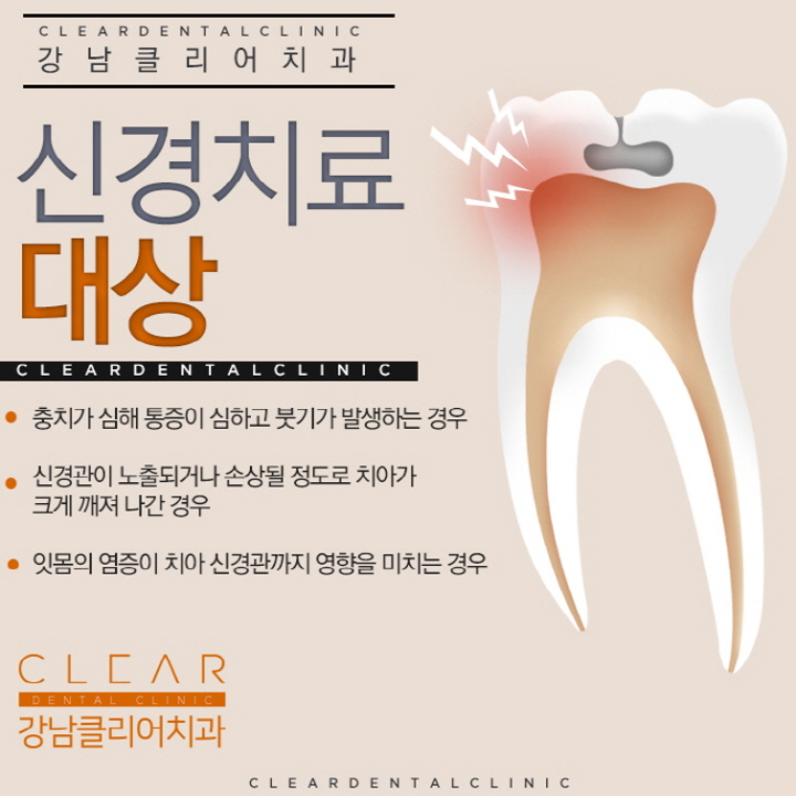치아 신경치료 과정 순서 통증 등 신경치료의 모든것 관련 이미지 3
