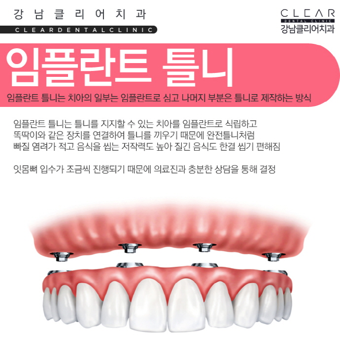 치아 보철치료 종류 심미보철 등 다양해 관련 이미지 12